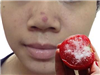Hàng triệu chị em "sửng sốt" với công dụng trị mụn bọc ở mũi chỉ bằng cà chua và chanh!
